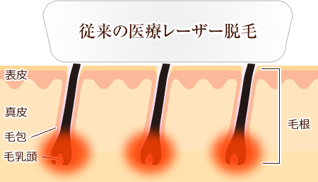 従来の医療レーザー脱毛